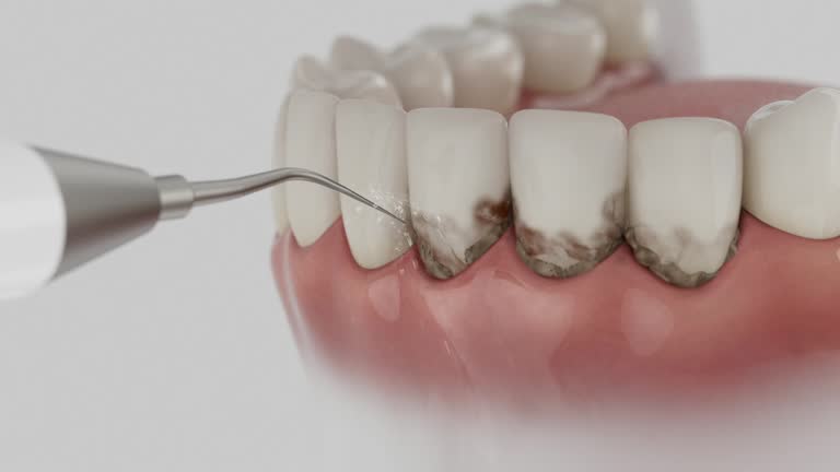 Trusted Dental Crowns And Bridges service in Atkins, VA - Dentist Open Now